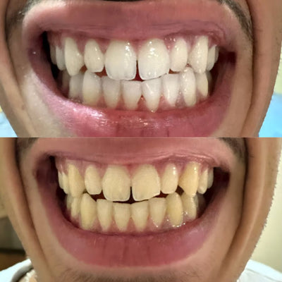 image of customers teeth color enhancement after using Halasmile products 