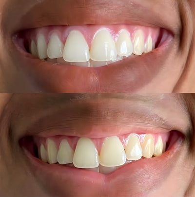 image of customers teeth upgrade after using teeth whitening products